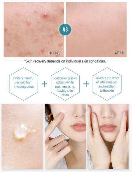 Тонер для проблемної шкіри особи Pyunkang Yul Acne Toner загоюючий, 150 мл 1464431560 фото